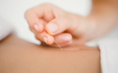 How Can TCM Acupuncture Support Your Overall Wellness?