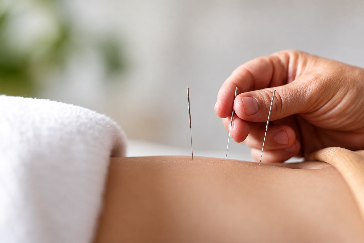 TCM Acupuncture at Thrive Massage Therapy & Wellness in Burlington